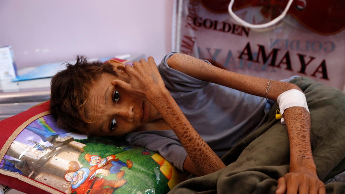 Im Jemen herrscht seit Jahren Hungersnot. Die Krise spitzt sich dort weiter zu, viele Kinder sind unterernährt.