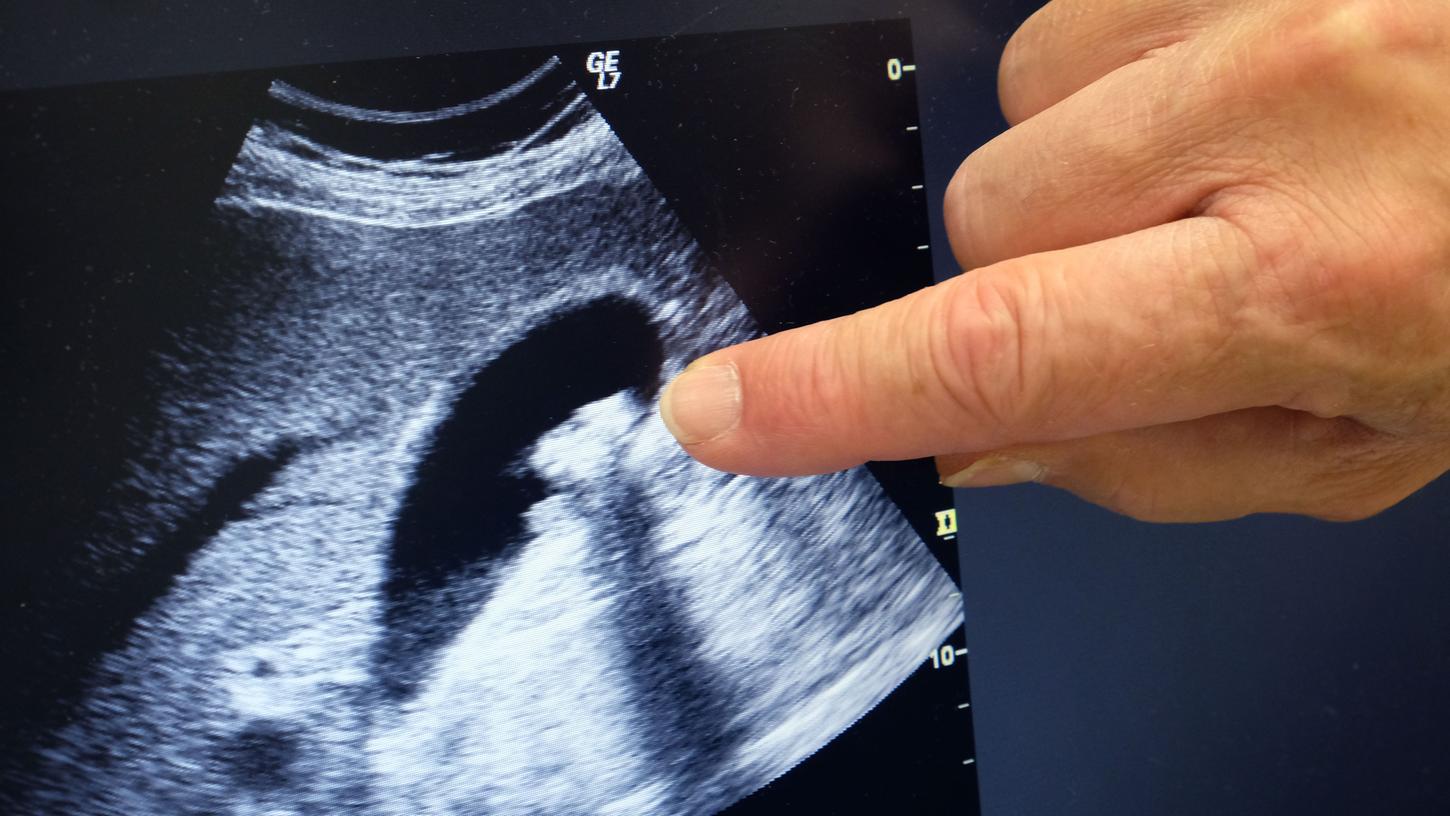 Auf einem Ultraschall-Bild ist eine mit Flüssigkeit gefüllte Gallenblase in Schwarz zu erkennen - deutlich zeichnen sich darin Gallensteine ab. Die Kristalle müssen nicht, können aber Schmerzen und gefährliche Entzündungen auslösen.