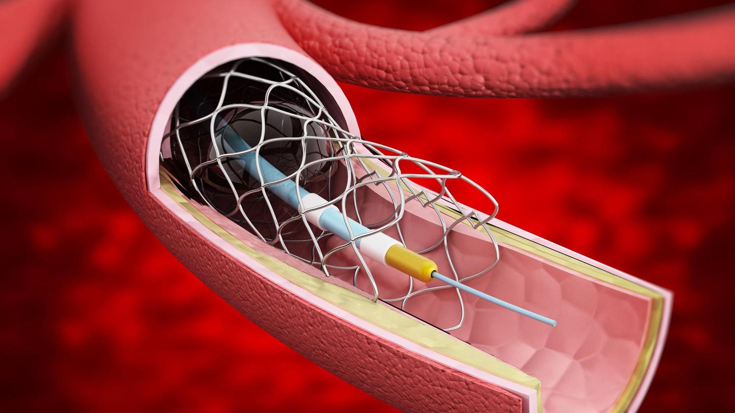 Diese Illustration zeigt, wie sich mittels eines Herzkatheters eine Gefäßstütze aus feinstem Draht - ein Stent - in das Blutgefäß einsetzen lässt.
Diese Illustration zeigt, wie sich mittels eines Herzkatheters eine Gefäßstütze aus feinstem Draht - ein Stent - in das Blutgefäß einsetzen lässt.