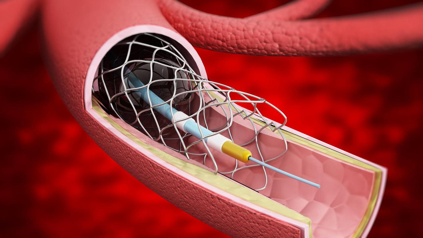 Diese Illustration zeigt, wie sich mittels eines Herzkatheters eine Gefäßstütze aus feinstem Draht - ein Stent - in das Blutgefäß einsetzen lässt.