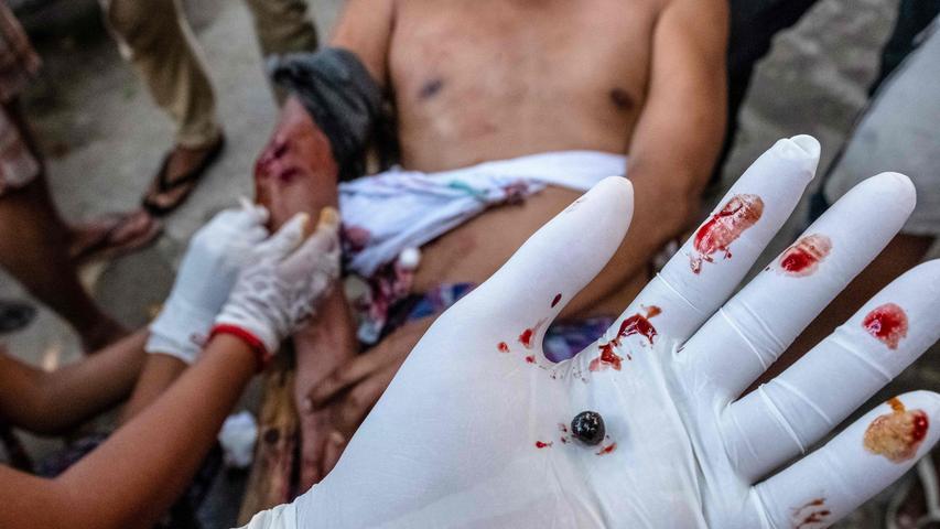 Bei den Protesten gegen den Militärputsch in Myanmar holte eine Ärztin diese Polizeikugel aus dem Körper eines Demonstranten.