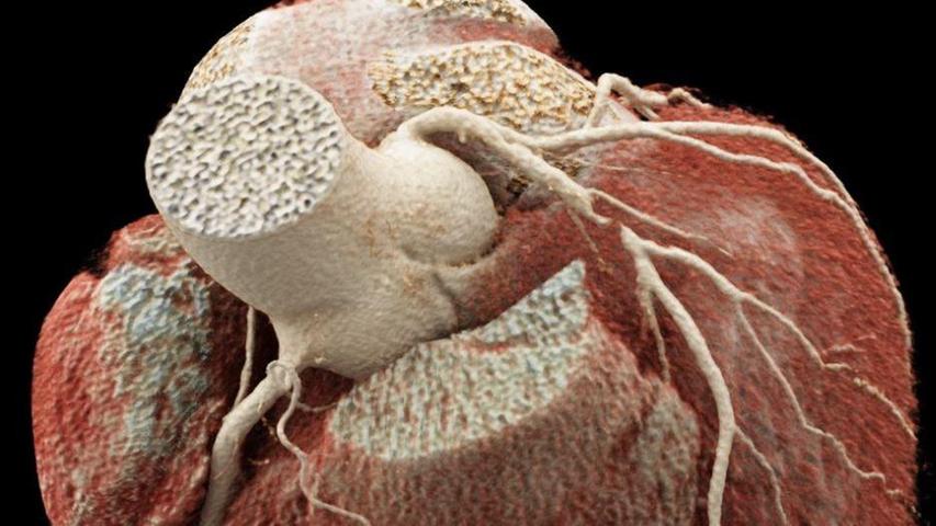 Verkalkte Arterien: Wer profitiert wirklich von einem "Herz-CT"?