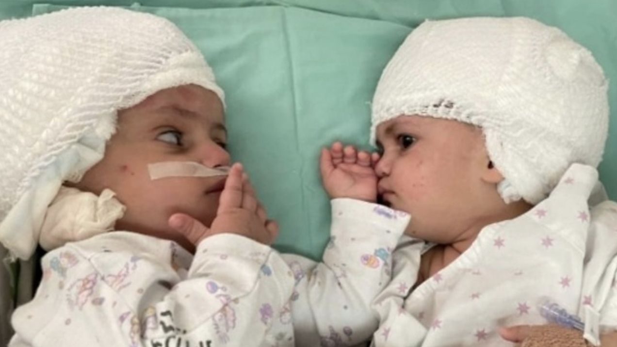 Wunder in Israel: Ärzte trennen am Kopf verbundene Zwillinge