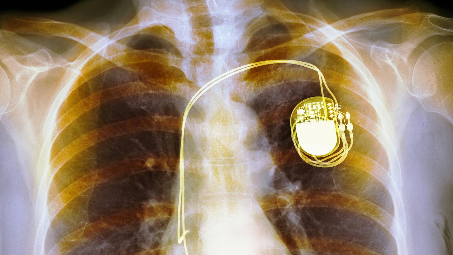 Das Röntgenbild zeigt einen klassischen Zweikammer-Herzschrittmacher im Brustkorb eines Menschen.
