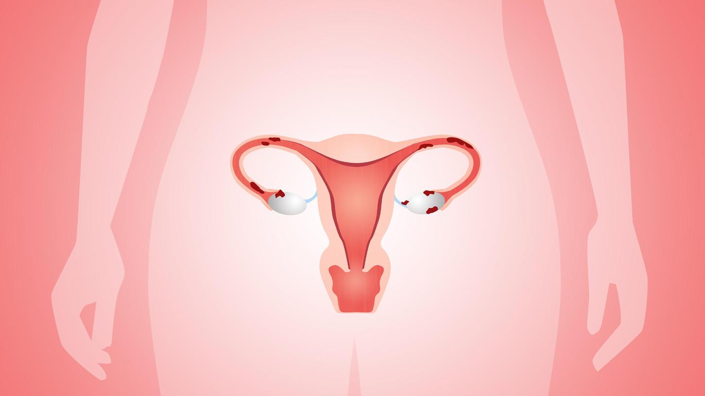 So in etwa können Zysten an den Eileitern durch eine Endometriose aussehen.