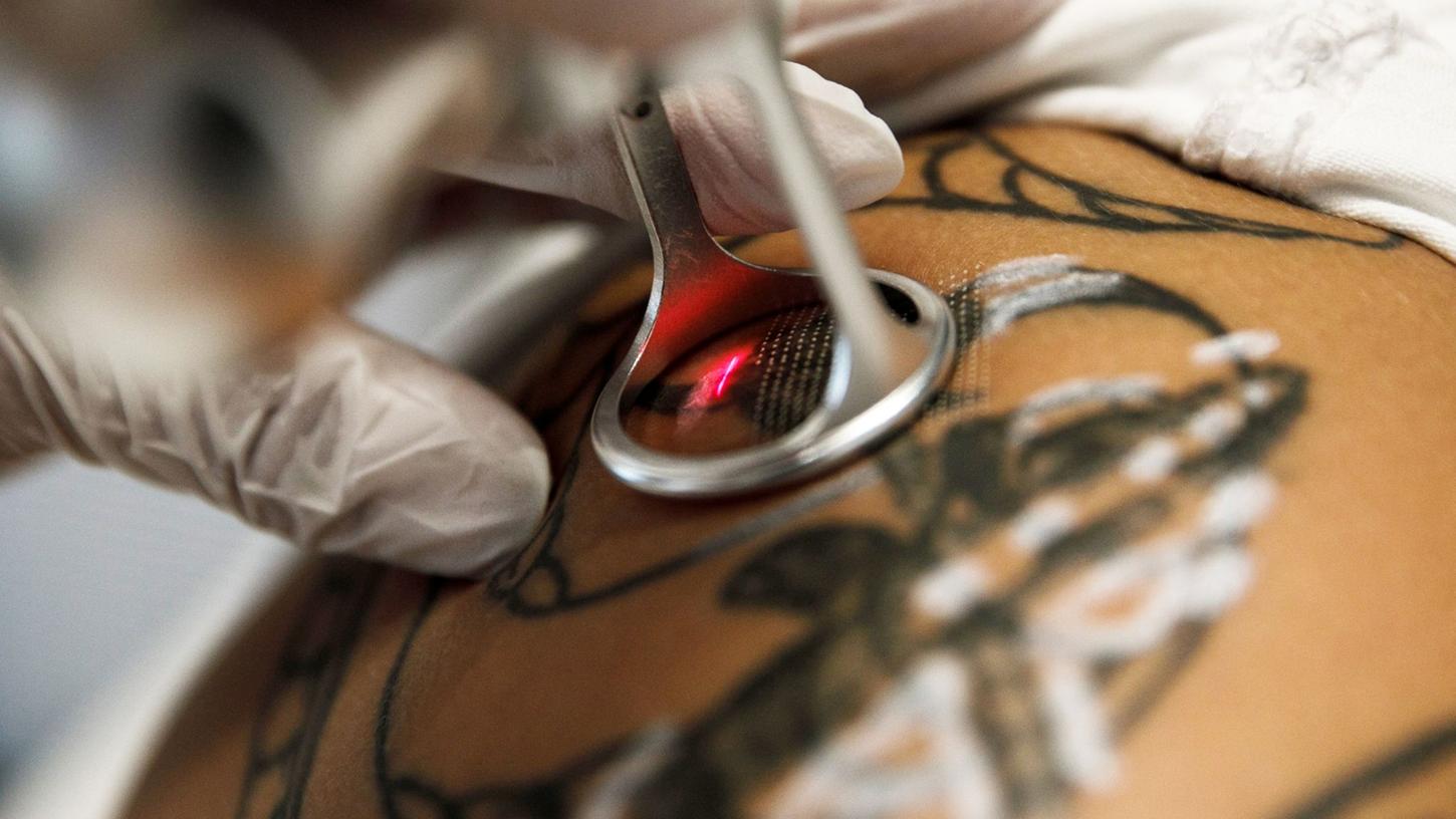 Tattoo soll weg: Tattoo soll weg: