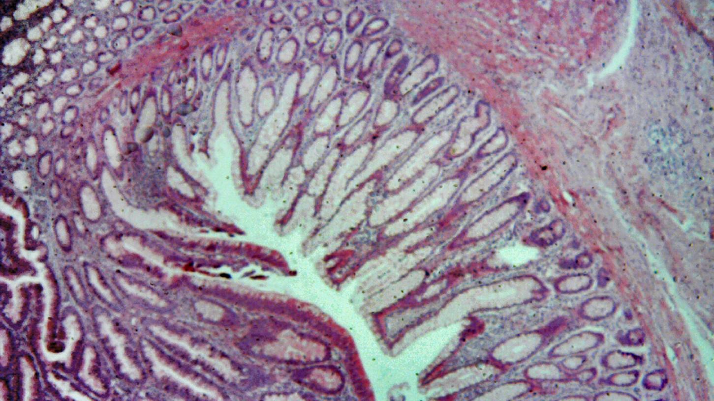 Die vier bayerischen Uniklinika bilden einen Standort des nationalen Tumorzentrums, das Bild zeigt einen histologischen Schnitt durch das Gewebe eines Dickdarm-Karzinoms.