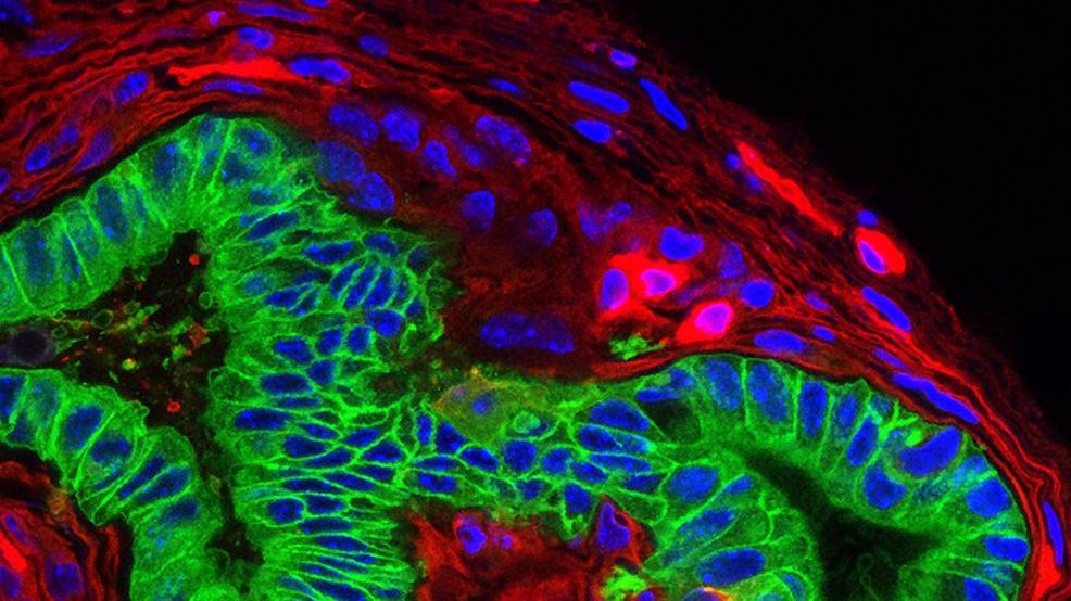 Die Abbildung zeigt in Grün ein Pankreaskarzinom (Bauchspeicheldrüsenkrebs) in einer Mauslinie mit mutiertem Kras-Gen. In Rot sind Zellen des Tumormikromilieus (Fibroblasten, Immunzellen, Endothelzellen) zu sehen.
Die Abbildung zeigt in Grün ein Pankreaskarzinom (Bauchspeicheldrüsenkrebs) in einer Mauslinie mit mutiertem Kras-Gen. In Rot sind Zellen des Tumormikromilieus (Fibroblasten, Immunzellen, Endothelzellen) zu sehen.