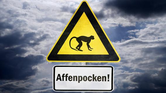 Nach Labor-Untersuchung: Erster Affenpocken-Fall in Franken bestätigt