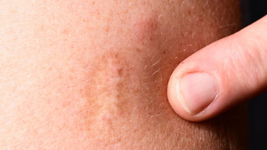 Kommt Pockenimpfung mit dem Affenpocken-Ausbruch zurück? Kommt Pockenimpfung mit dem Affenpocken-Ausbruch zurück?