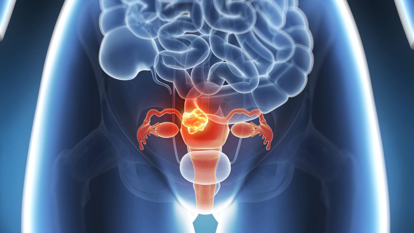 Frauen mit Verdacht auf Eierstockkrebs brauchen erfahrene Ärzte. 
