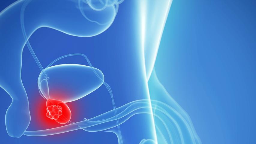 Prostatakrebs ist tückisch - nutzen Sie die Vorsorge! Prostatakrebs ist tückisch - nutzen Sie die Vorsorge!
