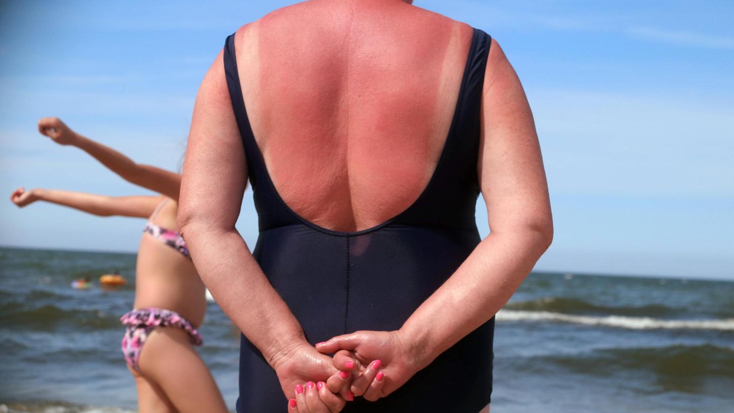Diese Sonnenanbeterin hat es definitiv übertrieben. Sonnenbrände erhöhen das Hautkrebs-Risiko erheblich, und viele Menschen im Rentenalter, die sich regelmäßig an südlichen Stränden bräunten, haben nun unter Spätfolgen zu leiden. Diese Sonnenanbeterin hat es definitiv übertrieben. Sonnenbrände erhöhen das Hautkrebs-Risiko erheblich, und viele Menschen im Rentenalter, die sich regelmäßig an südlichen Stränden bräunten, haben nun unter Spätfolgen zu leiden.