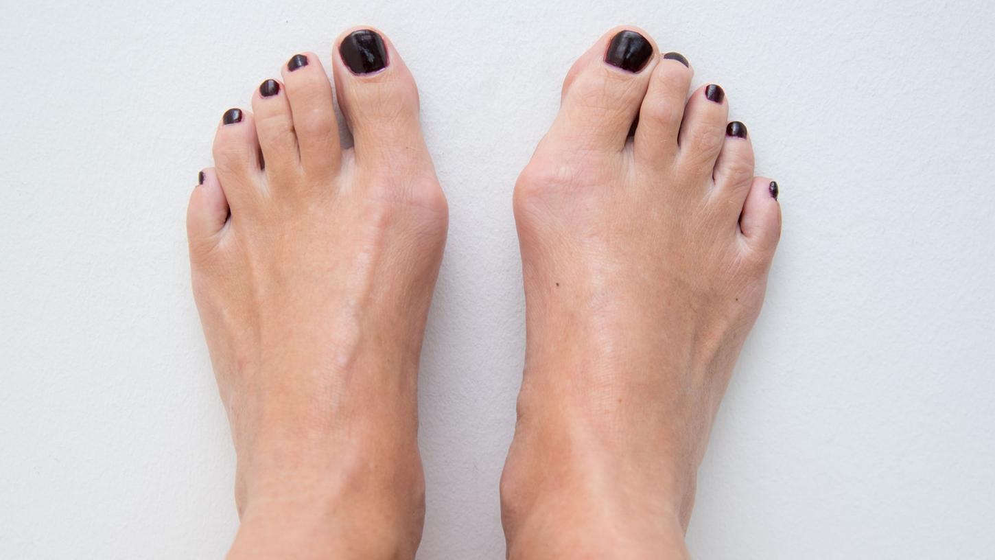 Wer einen Ballenzeh Hallux valgus hat, erkennt das unter anderem am Köpfchen des Mittelfußknochens. Es tritt bei der Fehlstellung oft stark an der Fußinnenseite vor. Wer einen Ballenzeh Hallux valgus hat, erkennt das unter anderem am Köpfchen des Mittelfußknochens. Es tritt bei der Fehlstellung oft stark an der Fußinnenseite vor.