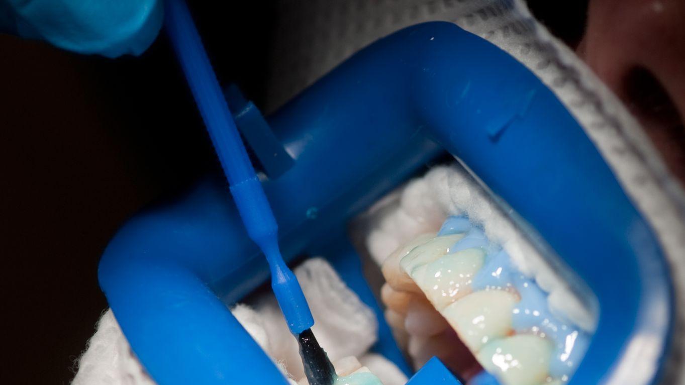 Auf die Zähne kommt beim Bleaching ein Bleichmittel - das blaue Gel schützt dabei das Zahnfleisch.