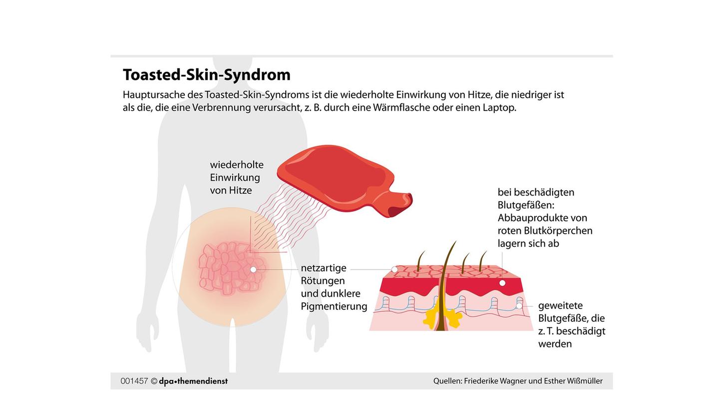 Gitterförmige Verfärbungen der Haut: Wer die an sich beobachtet, ist wahrscheinlich vom Toasted-Skin-Syndrom betroffen.