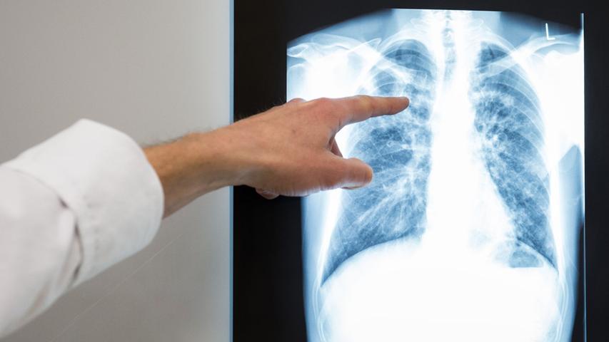 Schon 25 Infizierte: Tuberkulose-Ausbruch in Deutschland
