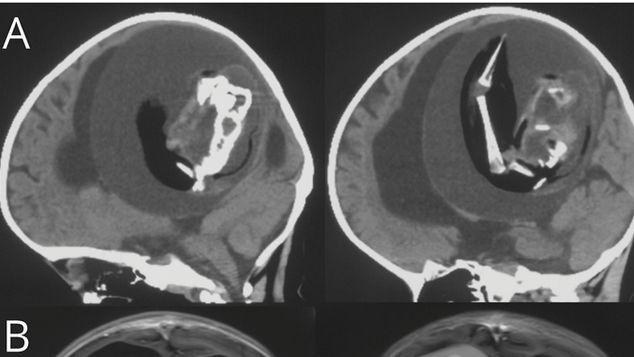 Bei einem Fetus in fetu entwickeln sich zunächst zwei oder mehr Föten im Mutterleib. Bei einem Fetus in fetu entwickeln sich zunächst zwei oder mehr Föten im Mutterleib.