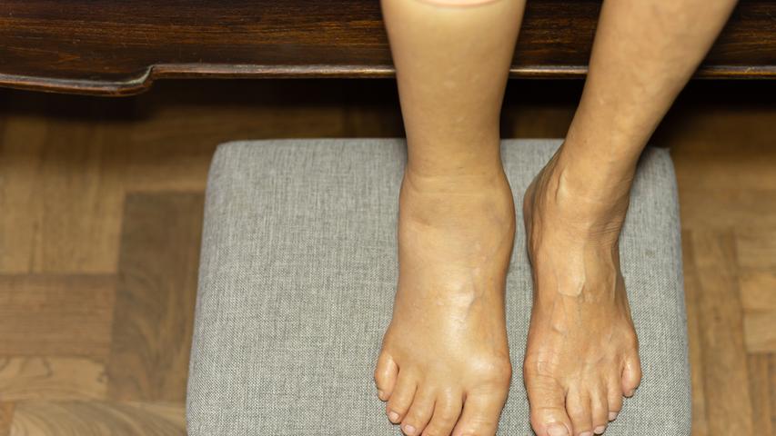 Links sieht man ein deutlich angeschwollenes Bein, rechts eins ohne Schwellung. Das kann ein Anzeichen für eine lebensgefährliche Thrombose sein.