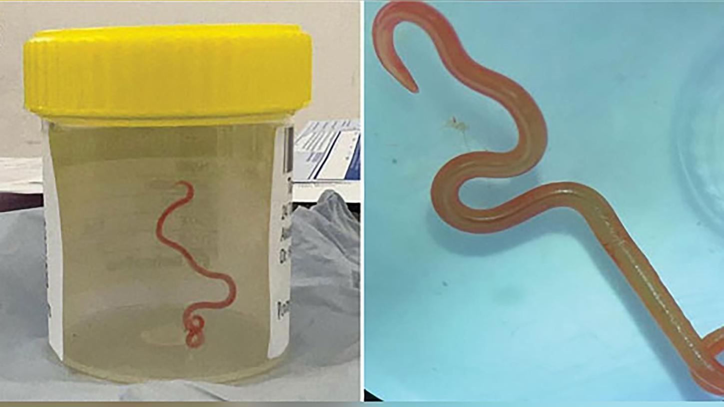 Der lebende Spulwurm "Ophidascaris robertsi" wurde im Gehirn einer 64-jährigen Australierin gefunden. Der lebende Spulwurm "Ophidascaris robertsi" wurde im Gehirn einer 64-jährigen Australierin gefunden.