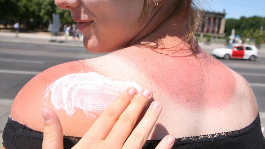 Bei Sonnenbrand sollte man Feuchtigkeitscreme auftragen, viel trinken und weitere Sonneneinstrahlung vermeiden.