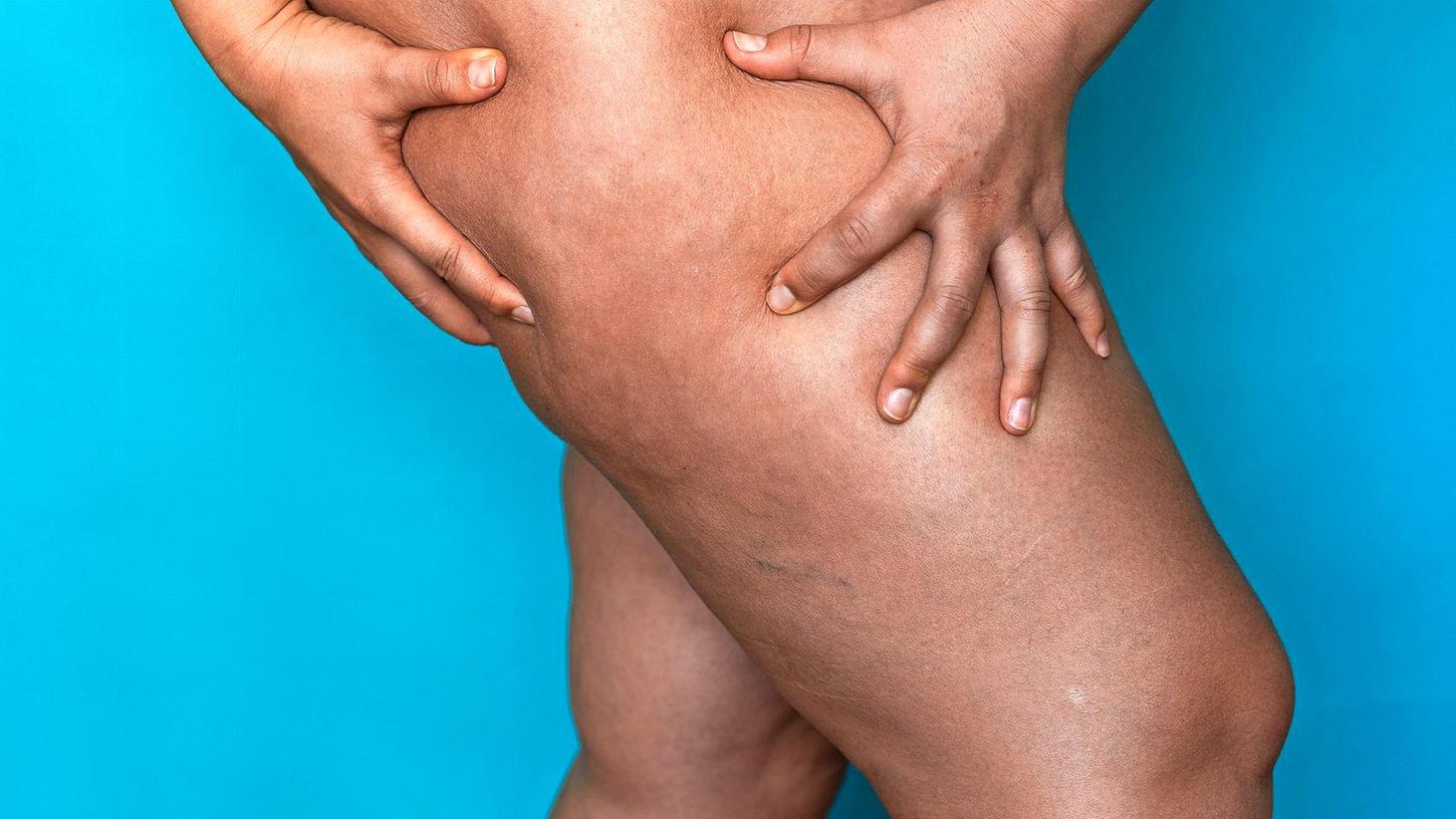 Wenn die Fettzellen krankhaft verändert sind, spricht man von einem Lipödem. Aber wie erkennt man das? Wenn die Fettzellen krankhaft verändert sind, spricht man von einem Lipödem. Aber wie erkennt man das?