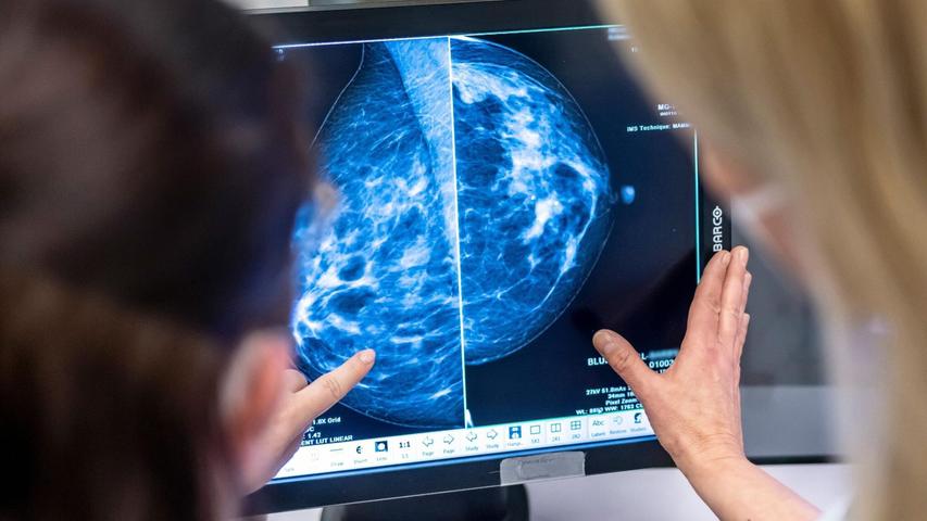 Die Altersobergrenze der kostenlosen Brustkrebsvorsorge wird auf 75 Jahre angehoben.