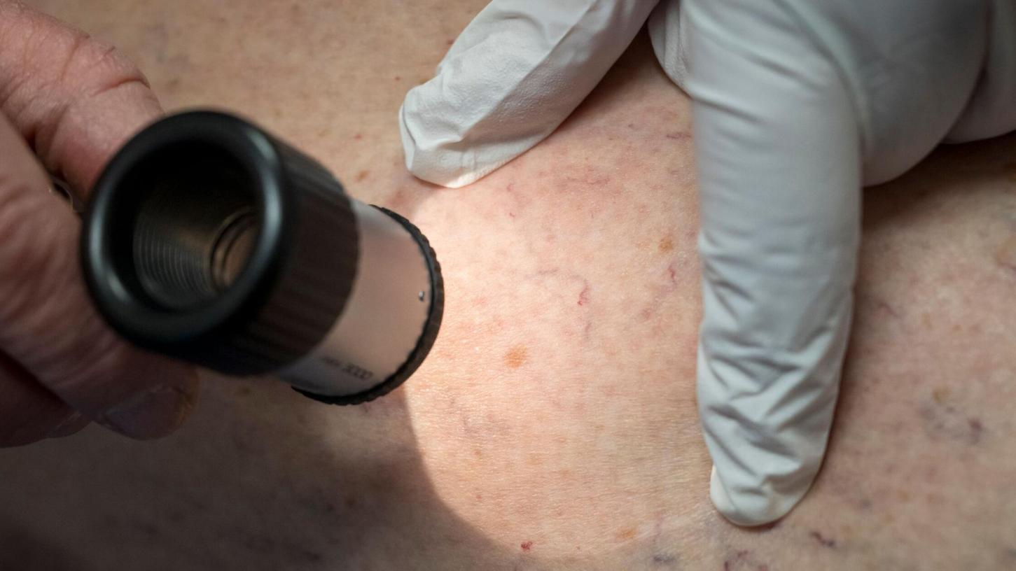 Die Zahl der Krankenhausbehandlungen von Hautkrebs stieg enorm an. (Symbolbild) Die Zahl der Krankenhausbehandlungen von Hautkrebs stieg enorm an. (Symbolbild)