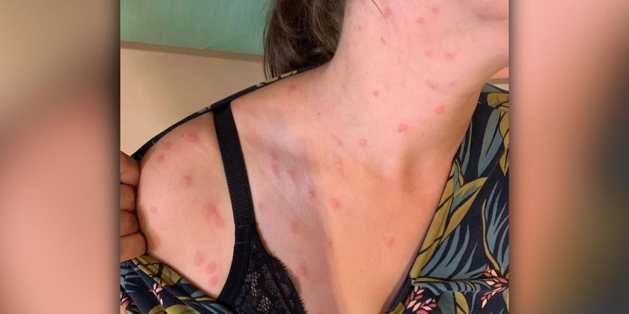 Rash after swimming in Lake Wöhrder: New theory about the incident in ...