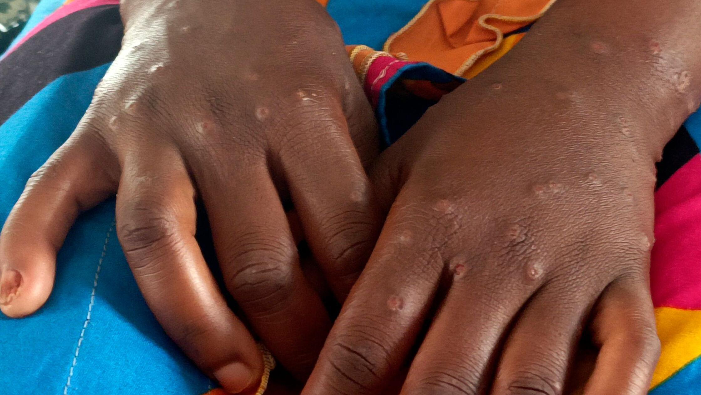 Internationale Notlage wegen Mpox aufgehoben