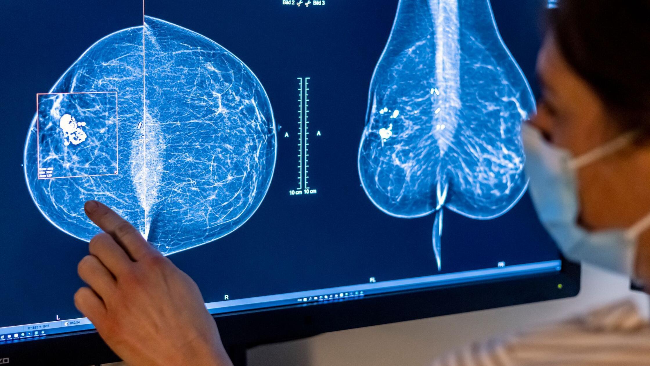 RKI-Fast-jeder-zweite-Deutsche-erkrankt-an-Krebs