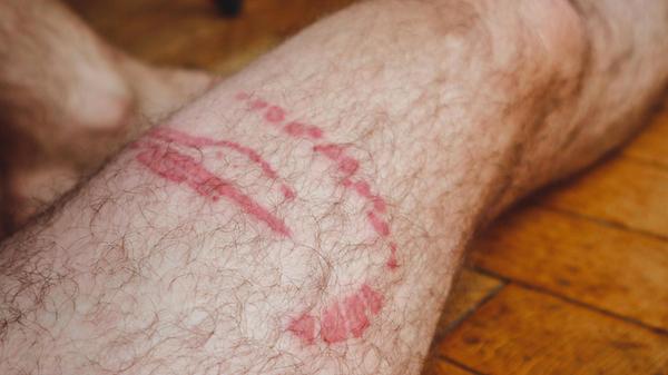 Verbrennung eines Quallenstichs am Bein eines Mann
