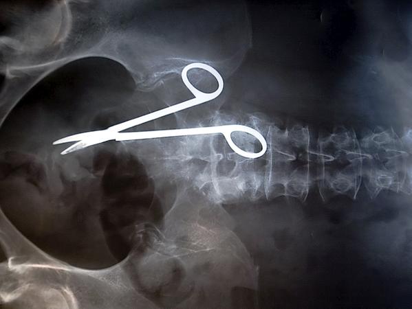 Der Klassiker unter den Behandlungsfehlern ist die im Patientenkörper vergessene Schere. Diese hier ist 17 Zentimeter lang. Der Klassiker unter den Behandlungsfehlern ist die im Patientenkörper vergessene Schere. Diese hier ist 17 Zentimeter lang.