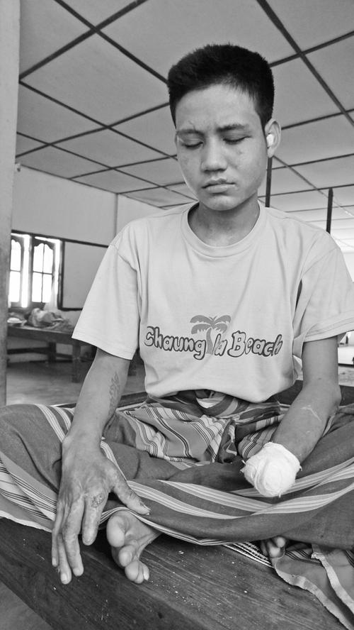 "Es ist jetzt immer dunkel. Manchmal denke ich mir, das kann nur ein böser Traum sein. Doch es wird nicht mehr hell." Naing Htoo, 17 Jahre, ein kriegsversehrter Milizkämpfer, verlor sein Augenlicht bei seinem ersten Kampfeinsatz.