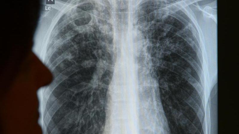 Die Tuberkulosebakterien befallen bevorzugt die Lunge. Anhaltender Husten und Schmerzen beim Atmen können Symptome sein.