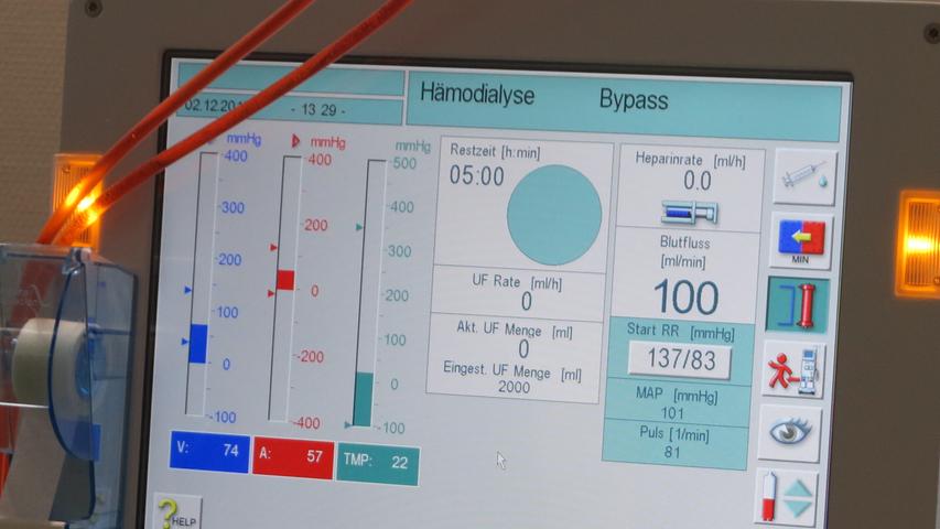 Die moderne Medizintechnik ist aufwendig und verlängert Leben. Der Monitor zeigt den Status der Dialysebehandlung.