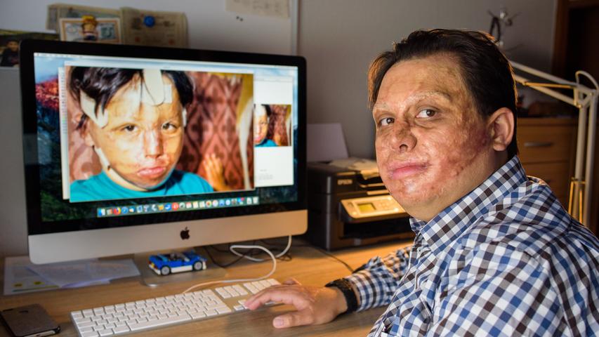 Marc-David Jung aus Losheim im Saarland ist eines der Opfer. Er wurde bei der Flugtagkatastrophe als Vierjähriger schwer verbrannt. Hier sitzt er vor einem Computer, auf dessen Bildschirm ein Bild von ihm als verletztes Kind zu sehen ist.