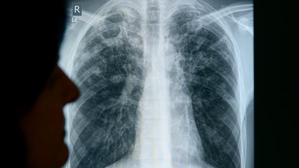 Häufigster Erreger der Lungenerkrankung Tuberkulose ist die Spezies Mycobacterium tuberculosis, die erstmals 1882 durch Robert Koch beschrieben wurde. 2019 gab es 747 nachgewiesene Infektionen in Bayern, davon 116 in Mittelfranken und damit im Verhältnis zur Einwohnerzahl am häufigsten im Freistaat.