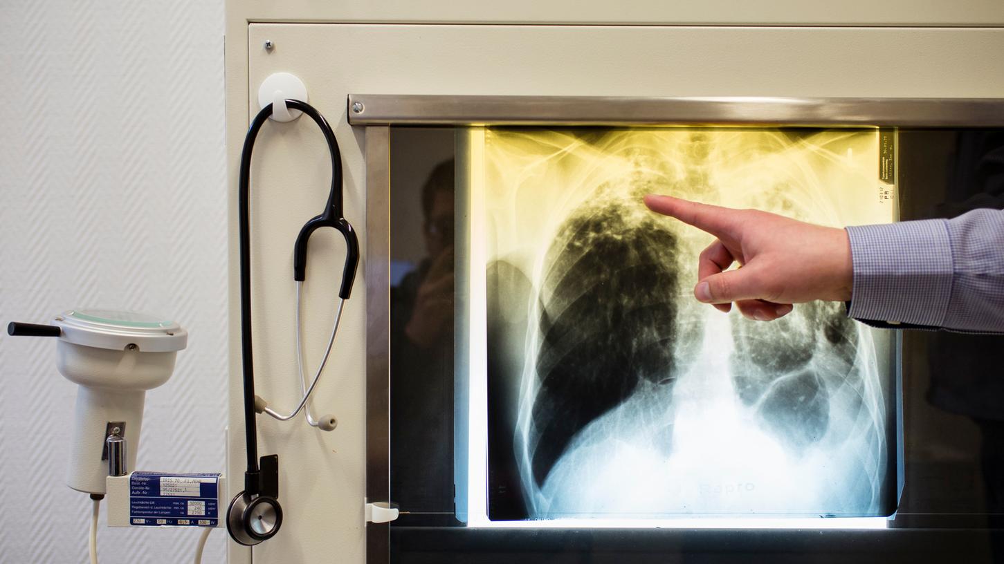 Die Röntgenaufnahme eines Patienten kann Auskunft darüber geben, ob eine Tuberkulose-Erkrankung vorliegt.