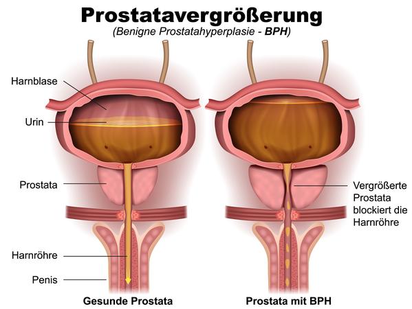 Die Abbildung zeigt eine Prostatavergrößerung.